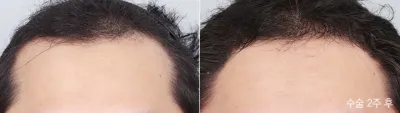 Before & After