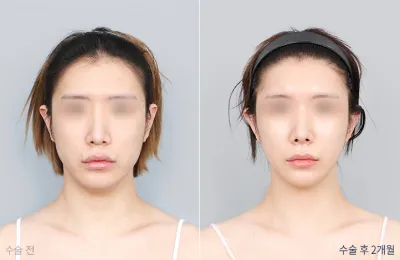 Before & After