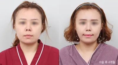 Before & After
