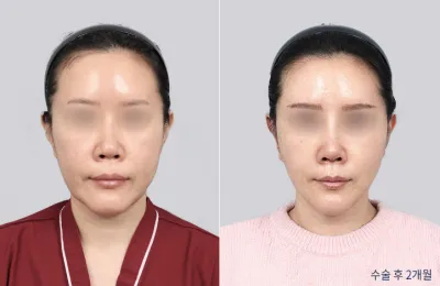 Before & After