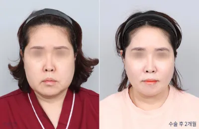 Before & After