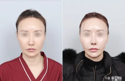 Before & After