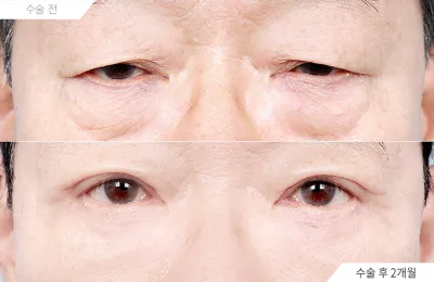 Before & After