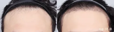 Before & After
