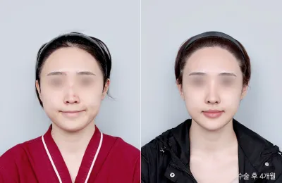 Before & After
