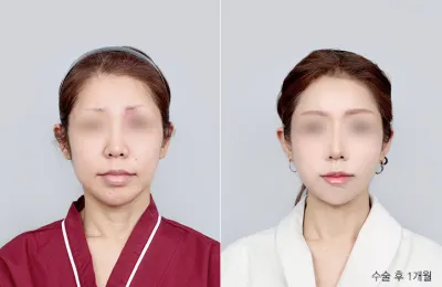 Before & After
