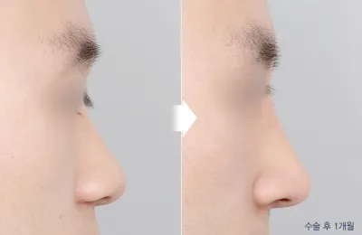 Before & After