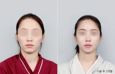 Before & After
