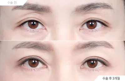 Before & After