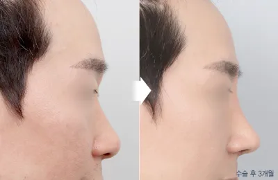 Before & After