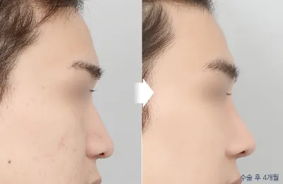 Before & After