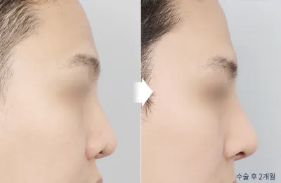 Before & After