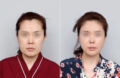 Before & After