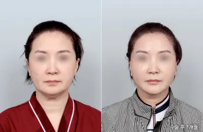 Before & After
