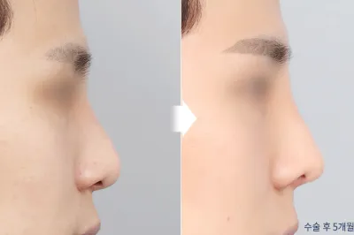 Before & After