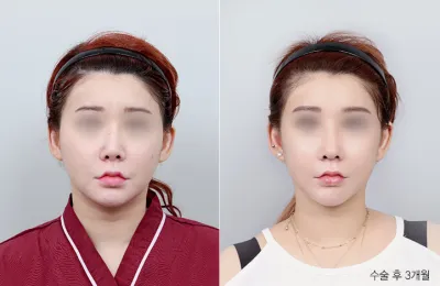 Before & After