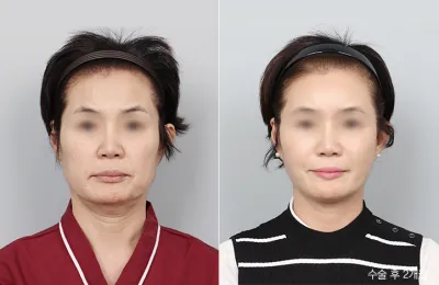 Before & After