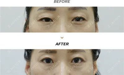 Before & After