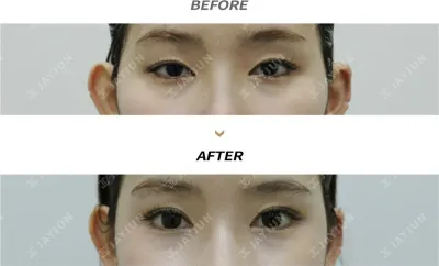 Before & After