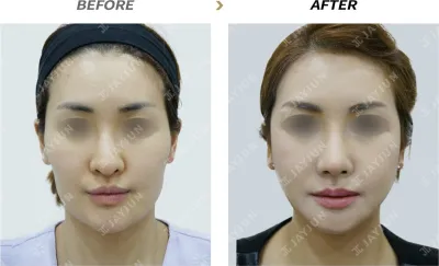Before & After