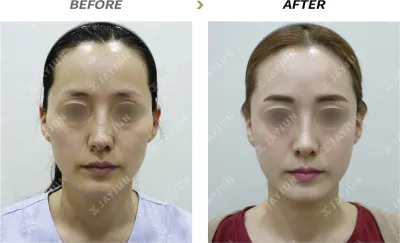 Before & After