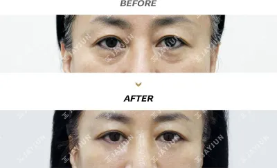 Before & After
