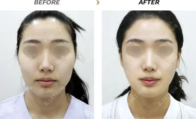 Before & After