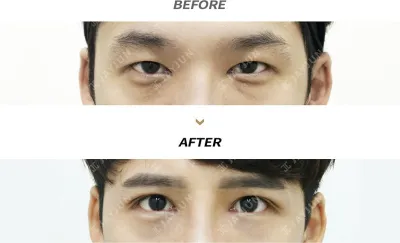 Before & After
