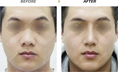 Before & After