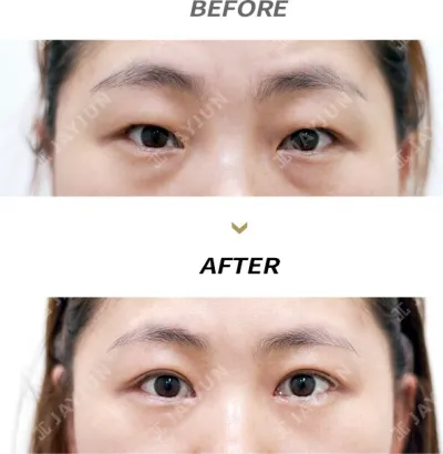 Before & After