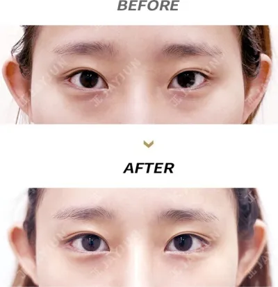 Before & After