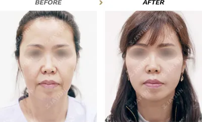 Before & After