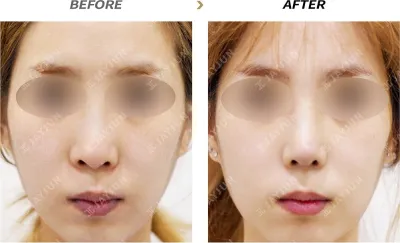 Before & After