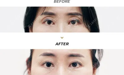 Before & After