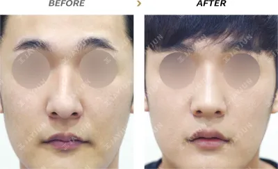 Before & After