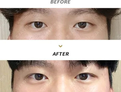 Before & After