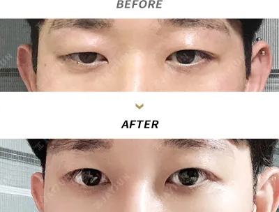 Before & After