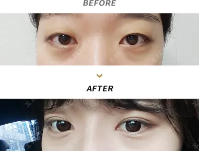 Before & After