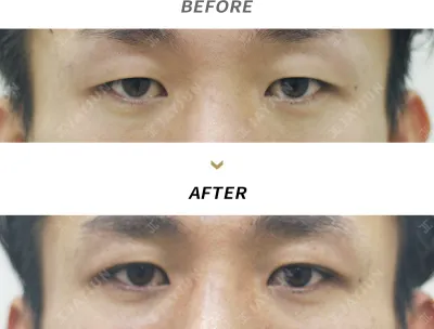Before & After
