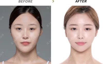 Before & After