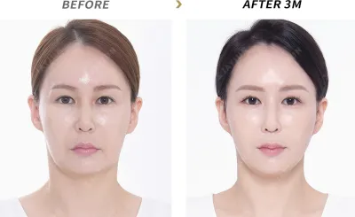 Before & After