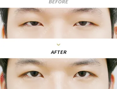 Before & After