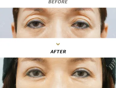 Before & After