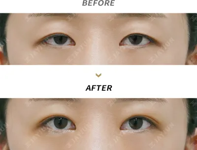 Before & After