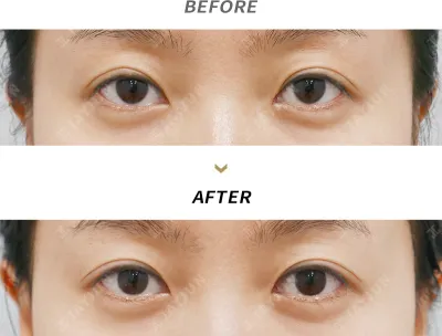 Before & After