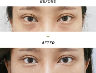 Before & After