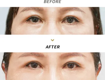 Before & After