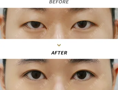 Before & After