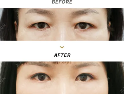 Before & After
