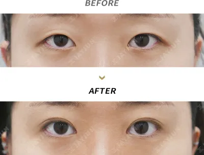 Before & After